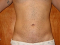 after Abdominal liposuction