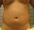 Before abdominal liposuction