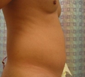 before abdominal liposuction