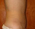 after abdominal liposuction