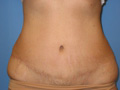 Abdominoplasty