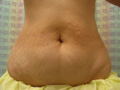 Abdominoplasty