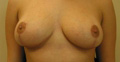 Breast Lift