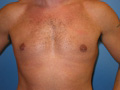 Gynecomastia
